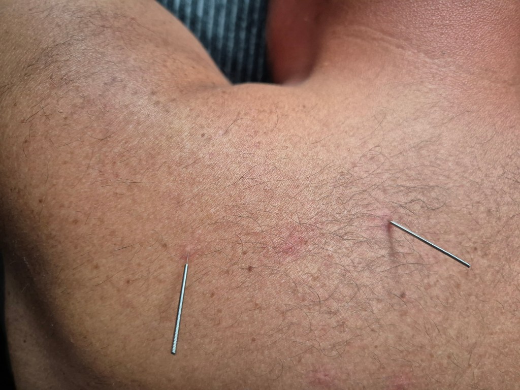 Zalety suchego igłowania w terapii&nbsp;mięśni