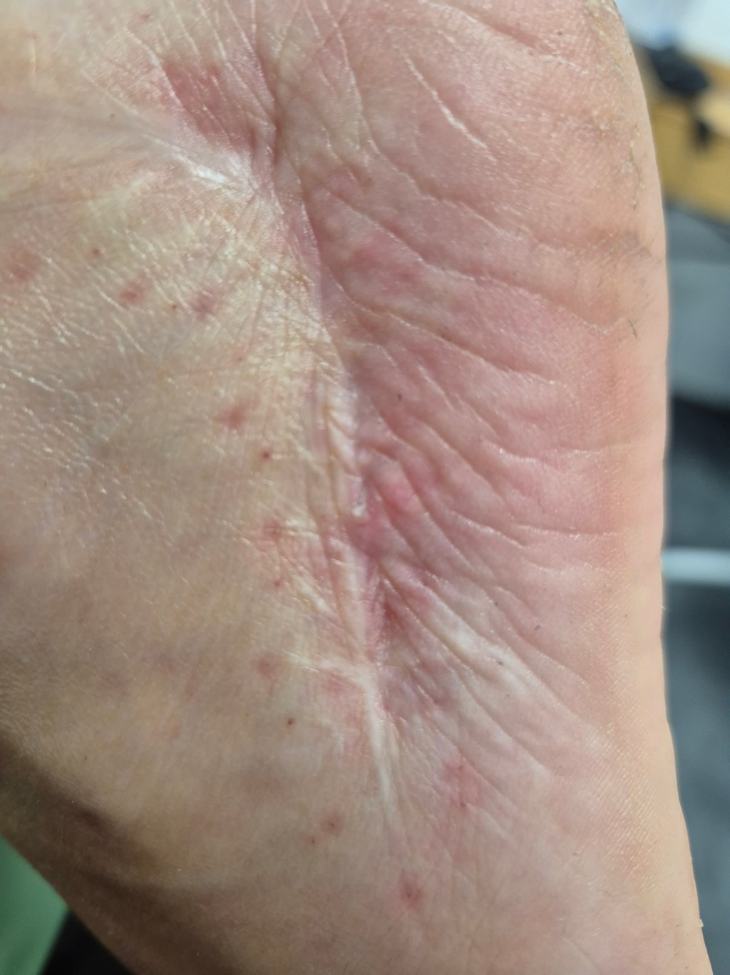 Terapia Blizn: efektywne techniki i&nbsp;metody